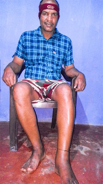 Chalice critical needs - medical expenses for Vasudev, Goa, India